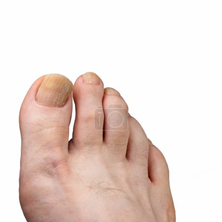 Photo for Toenail with nail fungus against white background - Royalty Free Image