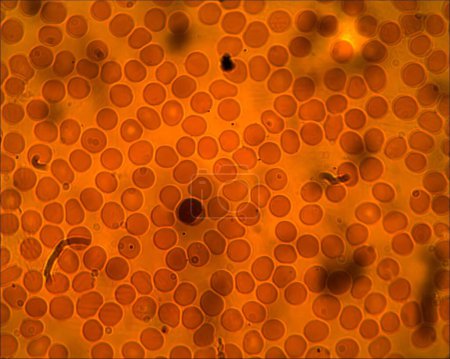 Photo for Magnification at 100x Reveals the Dance of Erythrocytes and Leukocytes: A Microscopic Journey Through the Human Immune System's Blood Cells - Royalty Free Image
