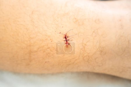 Téléchargez les photos : Plaie fraîche avec points de suture après l'opération de la peau. Photo de haute qualité - en image libre de droit