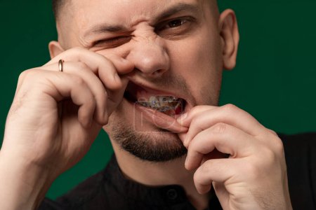 A man with braces on his teeth is contorting his face into a funny expression, showcasing his dental work as he jokes and amuses those around him.