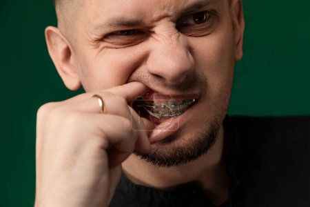 Un homme avec des accolades sur les dents est ludique contorsion son visage, créant une expression comique. Ses appareils orthodontiques sont visibles alors qu'il s'engage dans un moment amusant et léger.