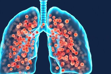 Pulmones. Pertussis. Tos ferina. Bordetella pertussis. Pulmones con bacterias. Diseño de pulmones con bacterias dentro de los pulmones que representan una enfermedad pulmonar.