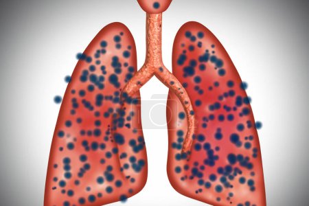 Lungs. Pertussis. Whooping cough. Bordetella pertussis. Lungs with bacteria. Design of lungs with bacteria inside the lungs representing a lung disease.
