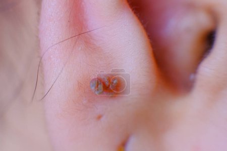 Foto de Foto de cerca de las verrugas de la piel en el lóbulo de la oreja de una niña - Imagen libre de derechos