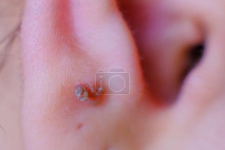 Photo for Closeup photo of skin warts on the earlobe of a girl - Royalty Free Image