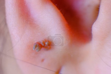 Foto de Foto de cerca de las verrugas de la piel en el lóbulo de la oreja de una niña - Imagen libre de derechos