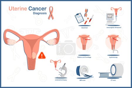 Concepto de ilustración vectorial médica plana del cáncer uterino.Diagnóstico de cáncer uterino y uterino.Análisis de sangre, tomografía computarizada, resonancia magnética, ultrasonido, biopsia endometrial, histeroscopia, dilatación y legrado.
