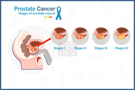 Flaches medizinisches Vektorillustrationskonzept von 4 Stadien von Prostatakrebs auf weißem Hintergrund mit blauem Band
