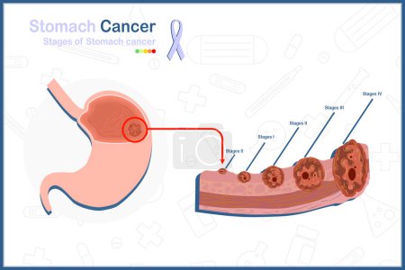 Téléchargez les illustrations : Concept d'illustration vectorielle médicale dans le style plat du cancer de l'estomac. 5 stades de cancer de l'estomac et de tumeur de l'estomac illustration.isolé sur fond blanc. - en licence libre de droit
