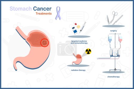 Téléchargez les illustrations : Illustration médicale vectorielle plate sur le concept de cancer de l'estomac. Traitement du cancer de l'estomac : chirurgie, chimiothérapie, radiothérapie. thérapie, thérapie ciblée et immunothérapie. - en licence libre de droit