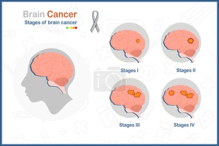 Hirnkrebs. Medizinische Vektorillustration im flachen Stil der vier Stadien des Gehirntumors. Isoliert auf weißem Hintergrund. Gesundheitsfürsorge und medizinische Konzepte.