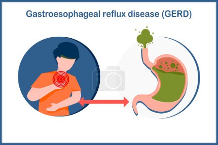 Téléchargez les illustrations : Medical vector illustration in flat style. Health care concept from acid reflux disease. Illustration of a human stomach filled with gas and a man in stomach and throat pain caused by acid reflux. - en licence libre de droit