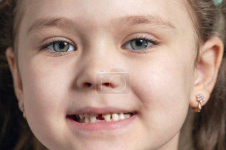 Photo for Portrait of a little girl with fallen and broken baby teeth. - Royalty Free Image