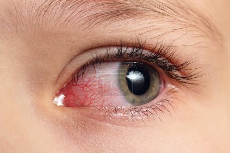 Nahaufnahme reizte infizierte rote Blutsauger Augen, Bindehautentzündung.