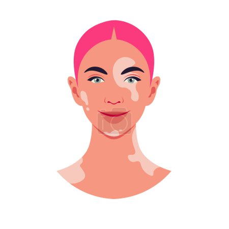 Téléchargez les illustrations : Le visage d'une femme heureuse avec dépigmentation vitiligo sur un fond rose. Illustration à plat vectoriel - en licence libre de droit