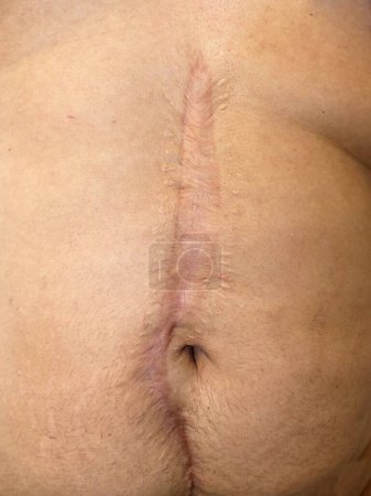 Large scar on the abdomen due to major surgery
