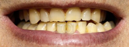Photo for Showing a deteriorated denture with yellow enamel and a lot of tartar, dental health - Royalty Free Image