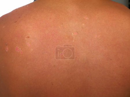 Foto de Eritema epitelial significativo después de una larga exposición al sol con ampollas y piel muerta con gran enrojecimiento, envejecimiento de la piel - Imagen libre de derechos