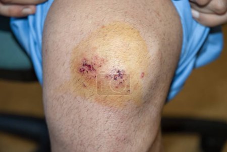 Oberflächliche Hauterosionen im Knie infolge eines Sturzes werden mit einer desinfizierenden Jodlösung geheilt