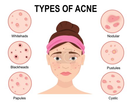 Tipos de acné con mujer aislada sobre fondo blanco. Problemas de piel. Concepto de belleza. Ilustración vectorial