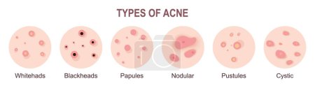 Illustration for Acne types, skin pimples blackheads and face comedones. Skin acne pimples, cosmetology and skincare problems. Vector icon set - Royalty Free Image