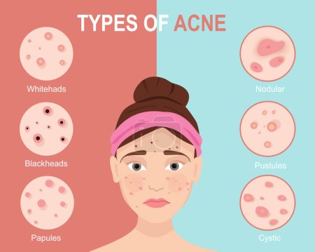 Ilustración de Tipos de acné con la mujer. Cosmetología y problemas de cuidado de la piel. Tipos de acné. Ilustración vectorial - Imagen libre de derechos