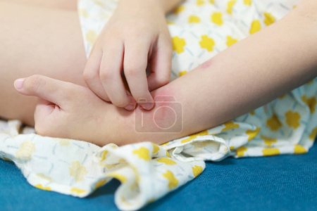 Foto de Little girl has skin rash allergy itching and scratching on her arm - Imagen libre de derechos