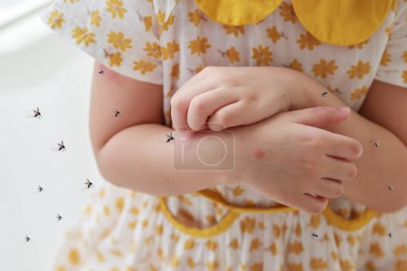 Foto de Niña tiene erupción en la piel alergia y picazón en el brazo por picadura de mosquito - Imagen libre de derechos