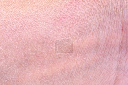 dry and dehydrated human skin texture background