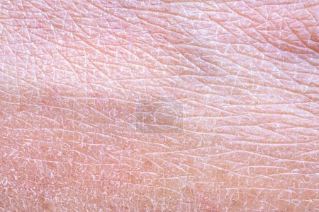 trockene und trockene menschliche Haut Textur Hintergrund