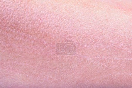Photo for Dry and dehydrated human skin texture background - Royalty Free Image