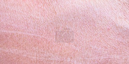 piel humana seca y deshidratada textura fondo