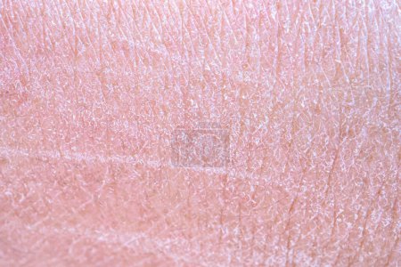 trockene und trockene menschliche Haut Textur Hintergrund