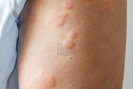 Joven asiático hombre tiene piel alérgica erupción en las piernas de picazón piel seca eczema dermatitis picaduras de insectos