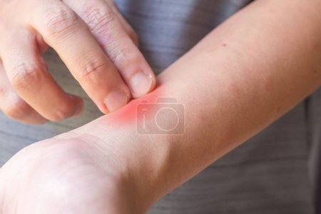 Junger asiatischer Mann juckt und kratzt am Arm von allergischem Juckreiz trockener Haut Ekzem Dermatitis Insektenstiche