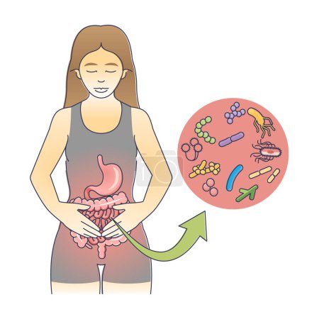 Ilustración de Gastroenteritis como diagrama de contorno de inflamación del tracto gastrointestinal. Esquema educativo con el estómago bacteriano y la infección intestinal vector ilustración. Virus médico causado diarrea o vómitos - Imagen libre de derechos