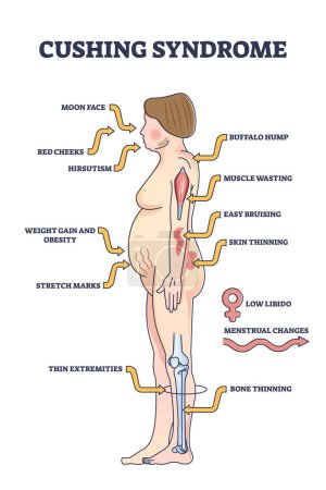Ilustración de Síndrome de Cushing lista de síntomas de alto nivel de cortisol esquema diagrama. Esquema médico educativo etiquetado con enfermedad de sobreproducción hormonal e ilustración del vector de respuesta corporal médica abdominal - Imagen libre de derechos