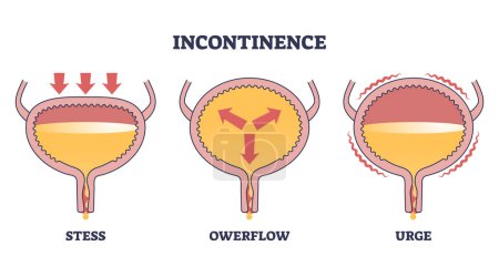 Inkontinenz-Problem mit Stress, Überfluss und Drang Typen skizzieren Diagramm. Beschriebene Krankheiten mit unbequemem Urin verursachen Vektorillustration. Erkrankungen des Körpers und der Blase.