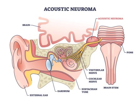 Neuroma acústico como tumor benigno cerca del esquema del nervio vestibular. Estructura de oído educativo etiquetado con partes internas y diagnóstico de trastorno médico ilustración vectorial. Balance y pérdida auditiva