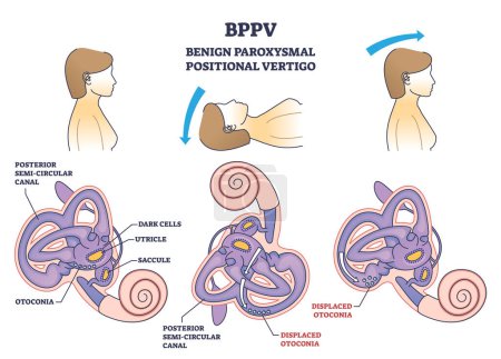 Schéma général du syndrome du vertige positionnel paroxystique bénin ou BPPV. Étiqueté schéma médical éducatif avec filature et sensation de vertige causent illustration vectorielle. Anatomie du canal auditif.