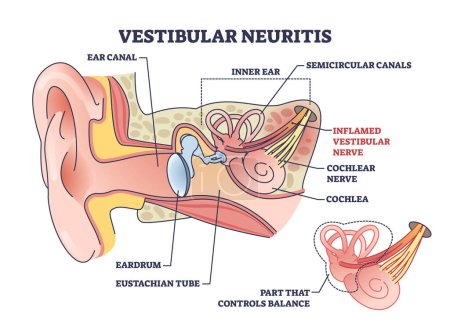 Neuritis vestibular como enfermedad de inflamación del nervio del oído interno diagrama de contorno. Etiqueta médica educativa condición del canal semicircular con mareos, vértigo y equilibrio pérdida vector ilustración.