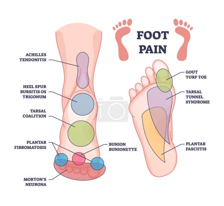 Les causes de douleur au pied à partir du diagnostic des zones et des taches douloureuses décrivent le diagramme. Étiqueté schéma éducatif avec maladie médicale, maladie ou traumatisme diagnostic illustration vectorielle. Tendinite, bursite