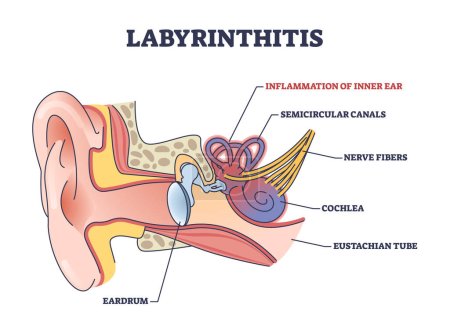 Labyrinthitis als Innenohrentzündung und medizinische Entzündung skizzieren das Diagramm. Beschriebenes Bildungsschema mit schmerzhaftem Zustand und medizinischer Ursache für Hör- und Gleichgewichtsverlust.