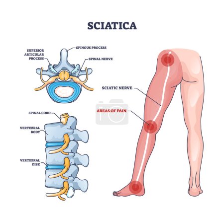 Schmerzbereiche des Ischias mit anatomischer Lage auf Beinumrandung. Beschriebenes Bildungsschema mit Symptomen medizinischer Probleme, Krankheiten oder Erkrankungen des Rückenmarks oder Rückenvektors.