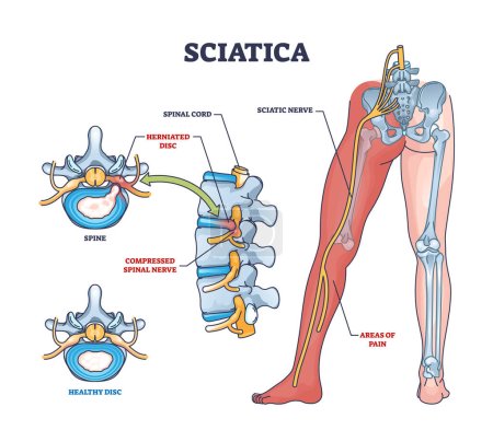 Ischias als Symptom eines Bandscheibenvorfalls und eines Rückenmarksnervenumrisses. Beschriebenes Bildungsschema mit Erkrankungen durch komprimierte Nerven und Vergleich mit gesunden Bandscheibenvektorillustrationen.
