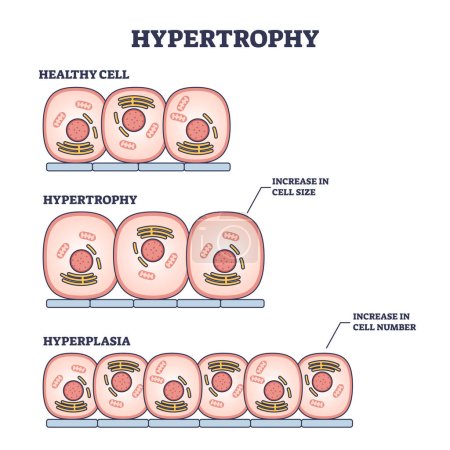 Illustration for Hypertrophy, hyperplasia or healthy muscular cells comparison outline diagram. Labeled educational scheme with increased cellular fluid after weight lifting or increase amount vector illustration. - Royalty Free Image