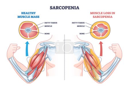 Sarcopenia as muscle mass loss and fatty tissue growth outline diagram. Labeled educational medical scheme with aging caused weakness and muscular pathology vector illustration. Obesity health issue.
