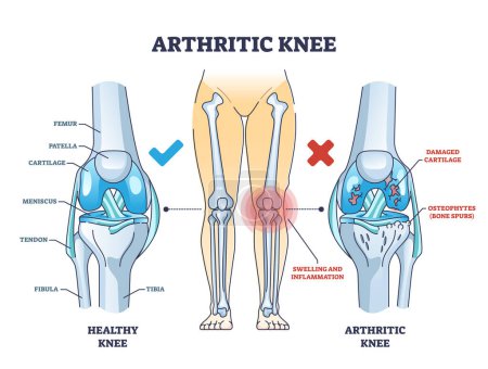 Artritis de rodilla o osteoartritis y huesos sanos diagrama de contorno de comparación. Esquema educativo etiquetado con cartílago dañado y espolones óseos ilustración vector diagnóstico. Pierna esquelética anatómica.