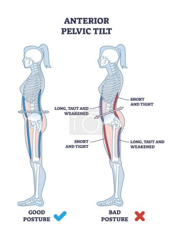 Inclinación pélvica anterior o APT como diagrama de contorno de postura anormal de la pelvis. Esquema educativo etiquetado con síndrome de lordosis aumentada de la columna lumbar y protrusión de la ilustración del vector del abdomen.