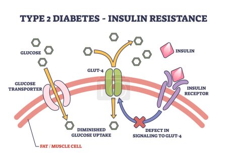 Diabetes tipo 2 y resistencia a la insulina explicación anatómica esquema diagrama. Representación de la ciencia médica etiquetada con receptor de insulina, defecto de GLUT e ilustración del vector de absorción disminuida.